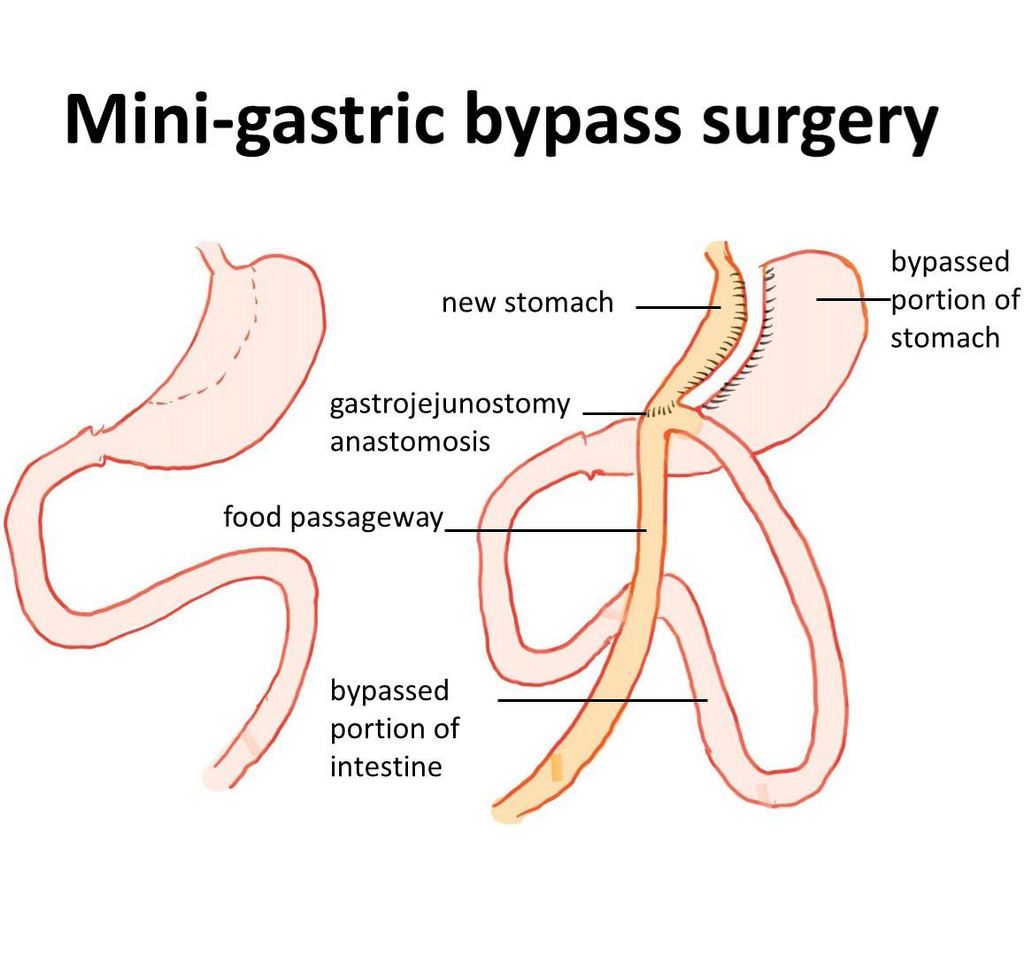 Decided on Bariatric Surgery Abroad? 4 Things to Consider
